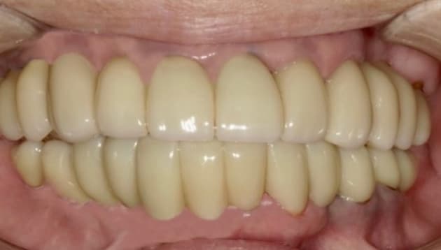 上下全顎インプラント治療症例