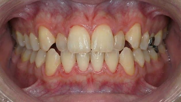 上顎部分矯正症例