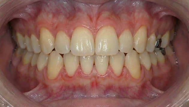 上顎部分矯正症例